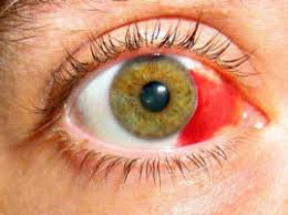 Subconjunctival Hemorrhage