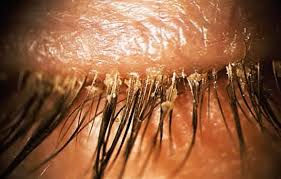 Blepharitis