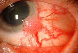 Conjunctival Tumor
