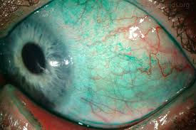 Dry Eye Syndrome