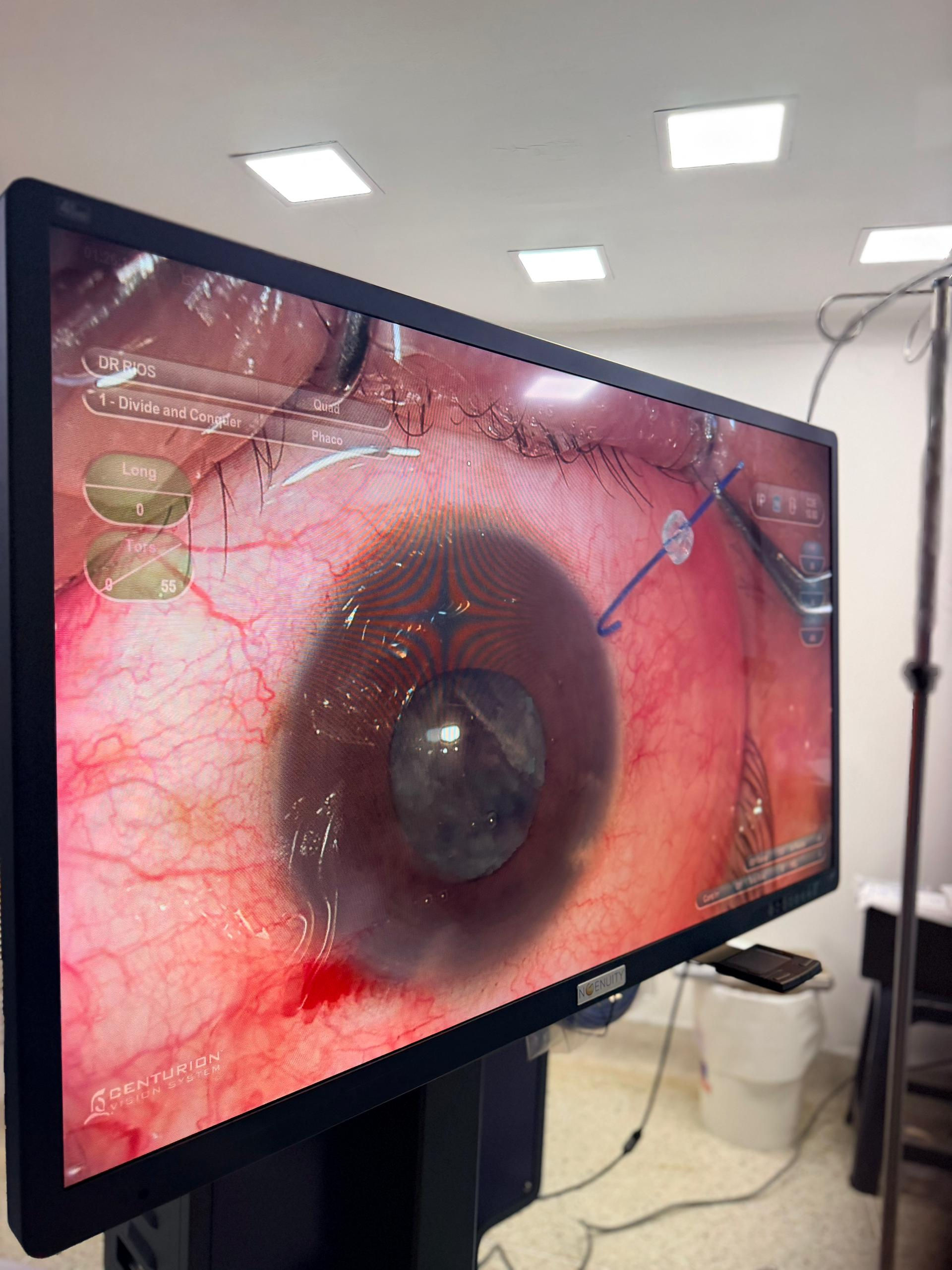 Sistema Ngenuity 3d de Alcon en la clínica  IDEO de Maracaibo, clínica de ojos.