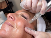 Nanoneedling – Advanced Course Certifications