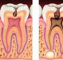 infeccion endo2_edited.jpg
