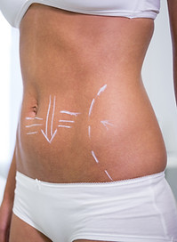 female-body-with-drawing-arrows-abdomen-liposuction-cellulite-removal.jpg