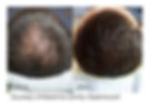 Hair Loss, Laser Treatments , Non-invasive, Greenwich, Connecticut. Greenwich, CT