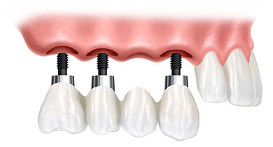 implant-bridge.jpg