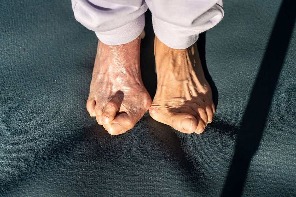 Overhead view of a senior woman's feet showing hammer toe, bunion, and hallux valgus.