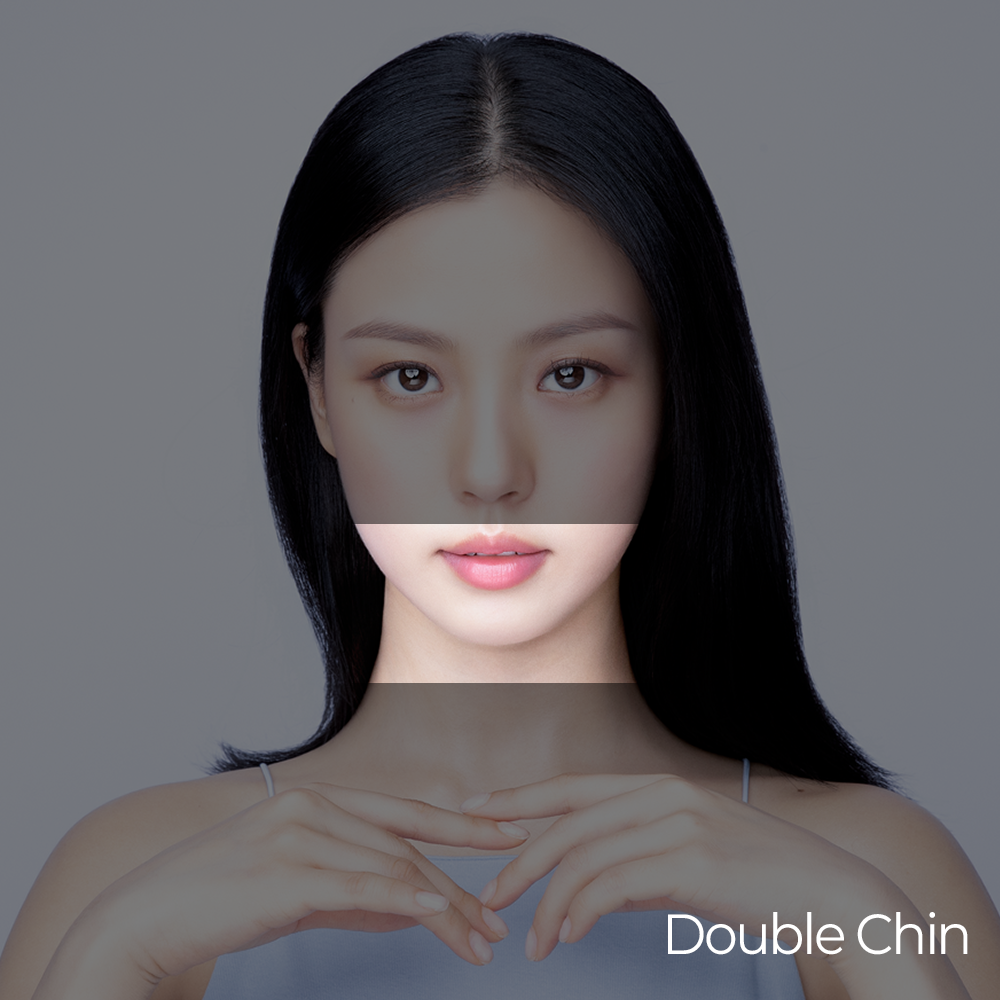 Ultraformer MPT Double Chin