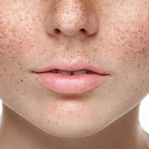 LaserPigmentation.jpg