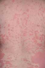Psoriazė 7