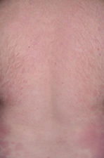 Psoriazė 9