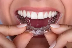 Pessoa inserindo um aparelho ortodôntico nos dentes brancos e clareados.