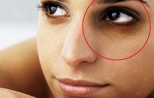 Dark circle treatment by Dr noopur mumba.jpeg