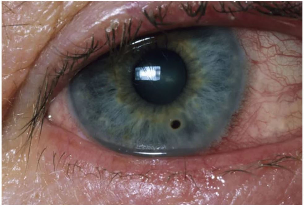 What Eye Problems Look Like Part 3
