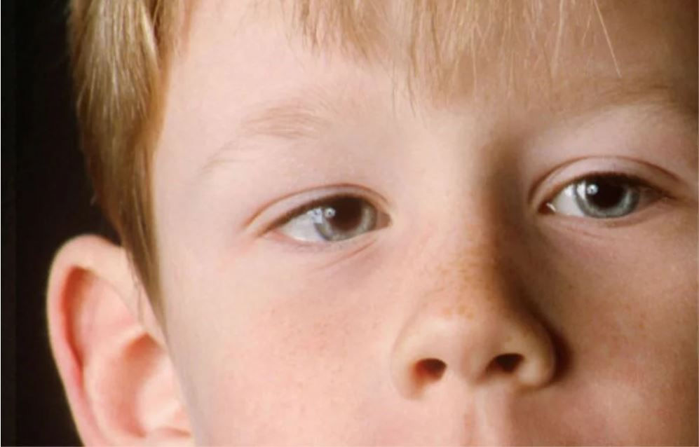 What Eye Problems Look Like Part 3