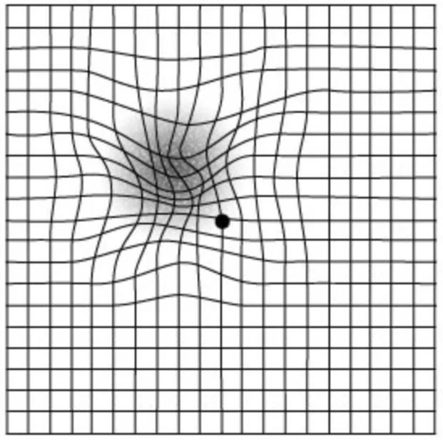 Macular Degeneration