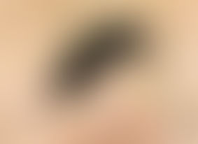 A dengue e os perigos da auto-medicação