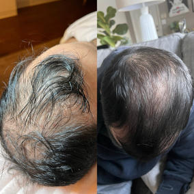 3 Treatments of ProCell Hair Restoration