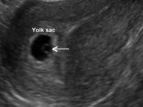 Miscarriage and Me: What I didn't understand and how I hope I can help others