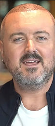 Estepera hair transplantation rewiews