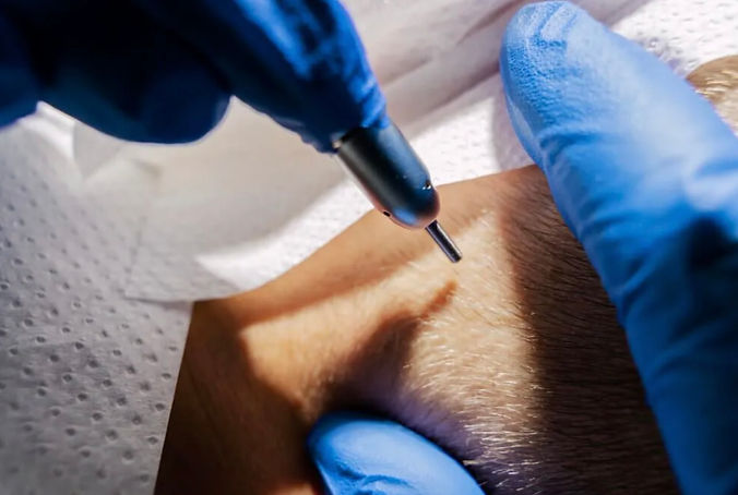 seyriverse-estepera-hair-transplant-istanbul-turkey