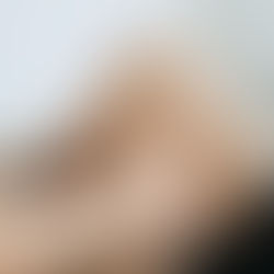 Baker’s Cyst: Why the Lump Behind Your Knee Isn’t What You Think