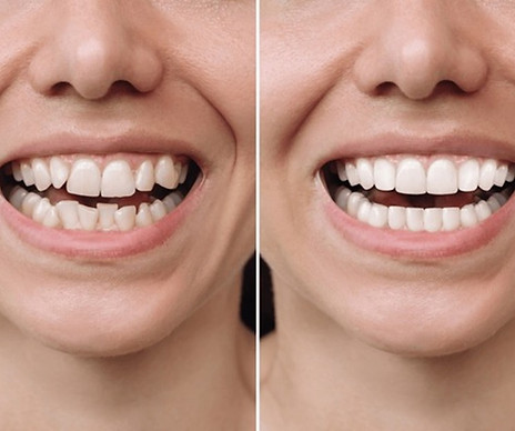 Invisalign Example