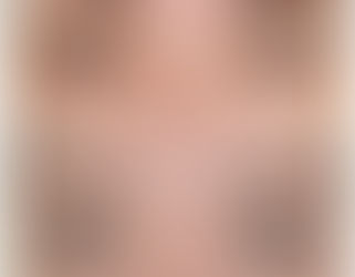 Skin Tightening Treatment Offers In Singapore - Beautyrecipe 