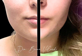 Bichectomia Bauru harmonização orofacial