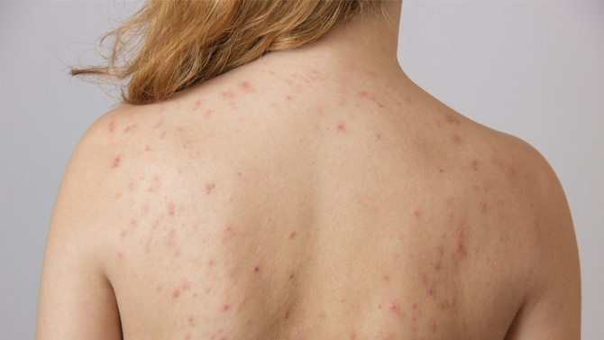 Back Acne