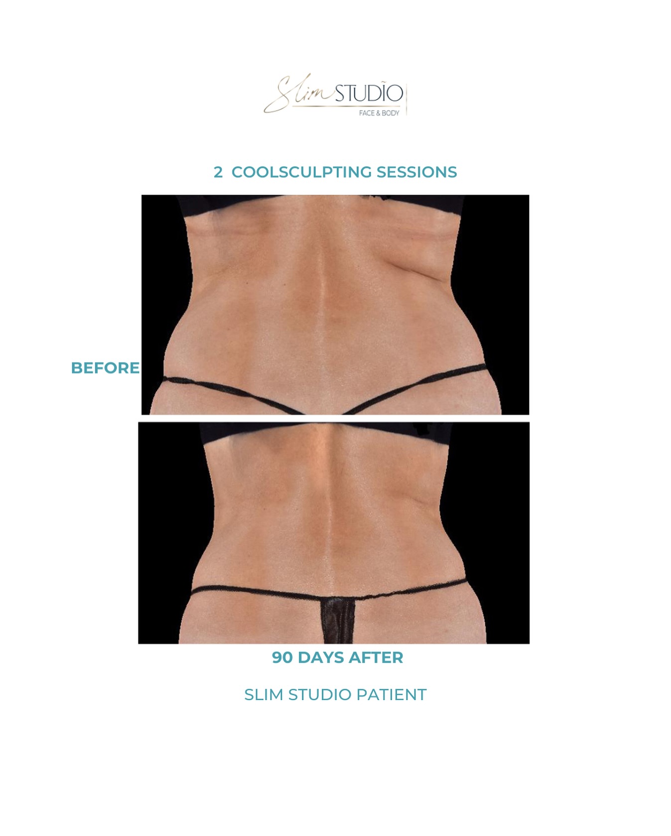 Before and after body contouring example