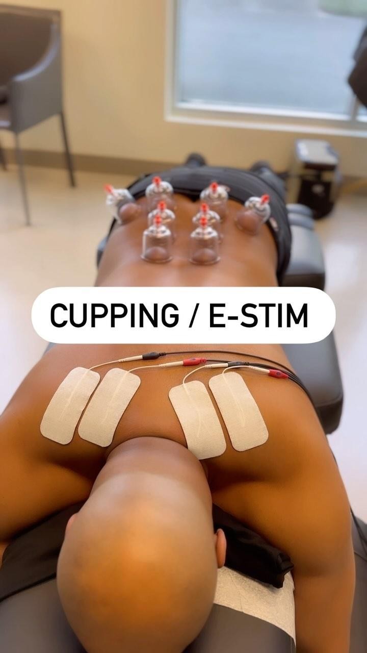 Close-up of patient’s low back with cups attached to electrical leads.