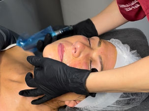 Fix Acne scars with Microneedling