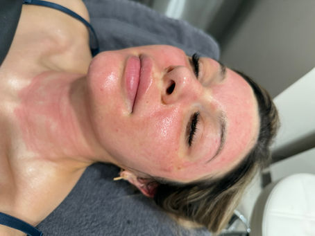 Results after microneedling