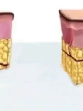 Monopolar RF and Bipolar RF delivering energy to skin layers