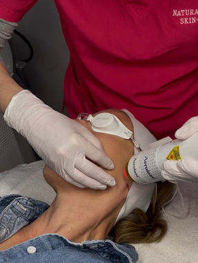 Aerolase Skin rejuvenation