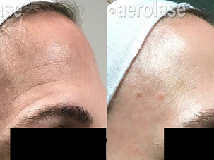 laser skin resurfacing Northville MI Natural Lash Skin Bar