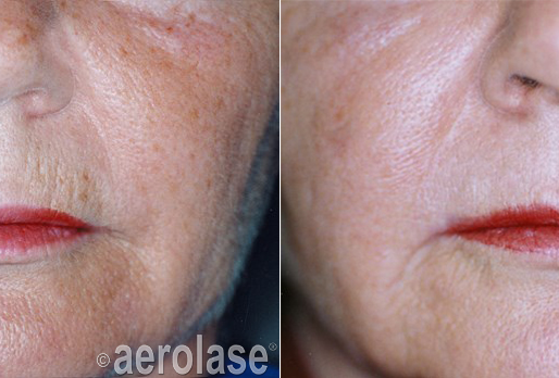 acne scar treatment Northville MI Natural Lash Skin Bar