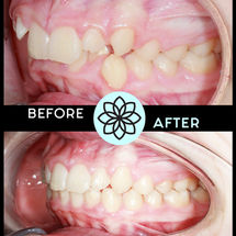 Kid Braces Results - Parker, Colorado | Youth and Teen Braces and Invisalign