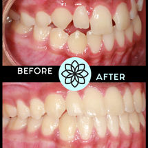 Top Colorado Orthodontist - Teen & Adult Treatment Photo Gallery | Lone Tree, Parker, Highlands Ranch