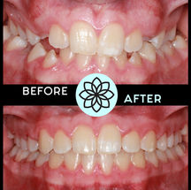 Creating Space for Proper Tooth Alignment - Top Colorado Orthodontist