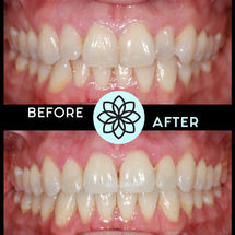 Orthodontic Treatment in Parker, Lone Tree, Colorado - Before & After