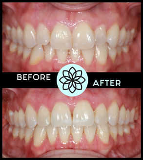 Adult Invisalign: Parker, Lone Tree, Highlands Ranch Orthodontist