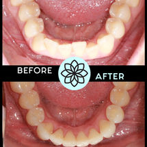 Top Colorado Orthodontist - Teen & Adult Treatment Photo Gallery | Lone Tree, Parker, Highlands Ranch