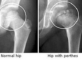 Bike Fit: Neck Pain Caused by Hip Limitations.