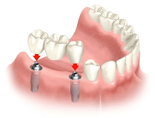 Clínica Prótese Dentária Em Americana