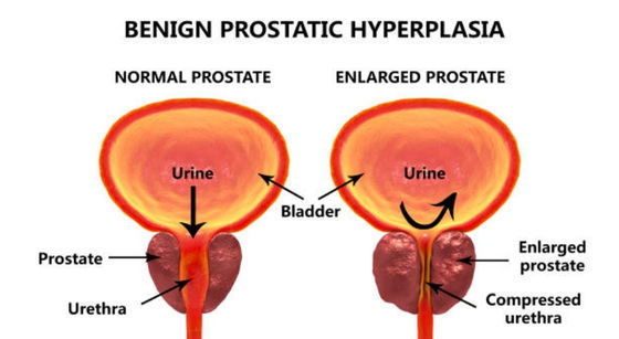 Understand what Benign Prostatic Hyperplasia is