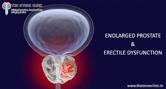 Can Enlarged Prostate Cause Erectile Dysfunction (Sexual Impotence)?