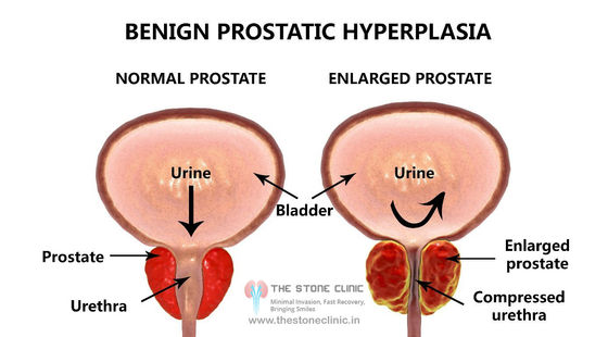 Benign Prostatic Hyperplasia: Symptoms, Causes & Treatments