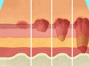 Pressure Sores – Treatment, Stages, and Symptoms